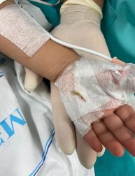 Bakıda 2 yaşlı körpə bir il nəfəs borusunda sümük parçası ilə yaşayıb - FOTO