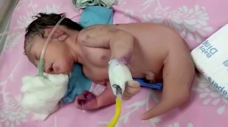 Yeni doğulan körpə həkimləri şoka saldı - FOTO