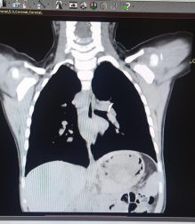 Bakıda 2 yaşlı körpə bir il nəfəs borusunda sümük parçası ilə yaşayıb - FOTO