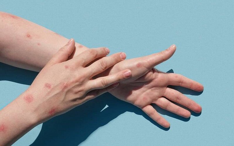 Yaponiyada meymunçiçəyinə ilk yoluxma qeydə alınıb